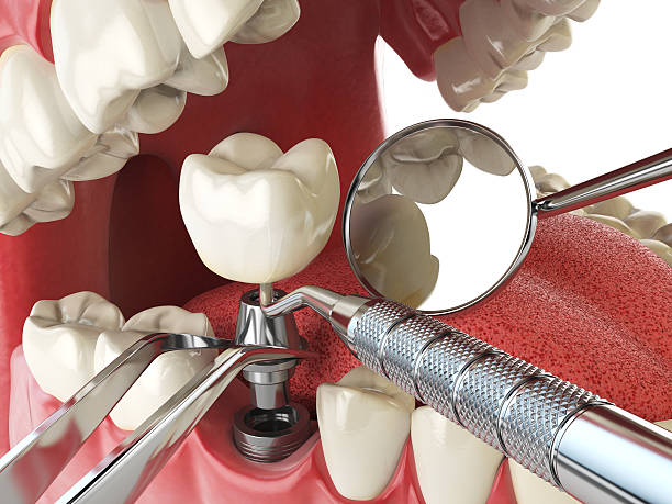 Best Emergency Tooth Extraction in Central City, PA